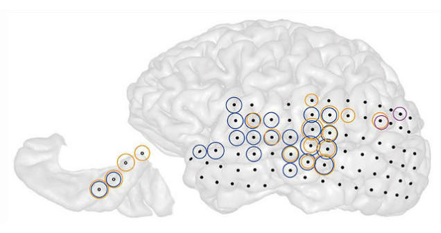 Research reveals “Tinnitus” directly linked to brain network, 1 out of 5 people affected